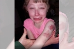 wisconsin, Wisconsin girl, 10 year old special needs child brutally bitten on arm while returning home in school bus, Special needs child