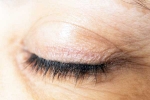 Eyelash Dandruff symptoms, Eyelash Dandruff latest, all about eyelash dandruff, Dandruff