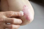 Skin disorders health issues, Skin disorders treatment, five common skin disorders and their symptoms, Skin disorders