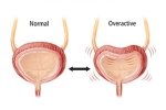 Overactive Bladder latest, Overactive Bladder prevention, here are some warning signs of an overactive bladder, Obesity