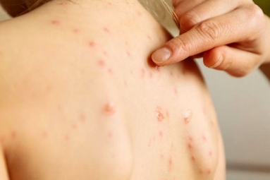 Measles Outbreak: New York City Declares Health Emergency, Unvaccinated Faces Fine of $1,000