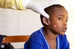 Monkeypox Outbreak latest, Monkeypox Outbreak breaking, is monkeypox outbreak coming to india, Congo