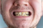 Nicotine stains irreversible, Nicotine stains research, are nicotine stains on your teeth irreversible, Cigarette