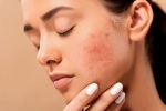 skin care products, dermatologist, 10 ways to get rid of pimples at home, Dandruff