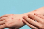 Monkeypox research, Monkeypox study, study says that the symptoms of monkeypox are different from earlier, Tedros adhanom ghebreyesus